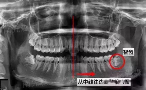 我有一颗小智齿,我从来也不拔,后来我截骨了