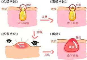 闭口不白头怎么弄好看，闭口不冒头的闷痘怎么处理(闭口不长出来怎么办)