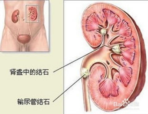 输尿管结石和膀胱结石有哪些鉴别