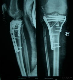 一组胫骨近端骨折手术图片
