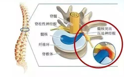 腿抽筋,别盲目补钙 这些才是真正原因 