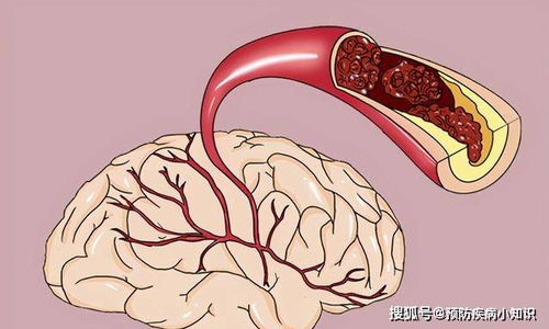 为何脑梗患者逐年增多呢 医生 和肥肉无关,这种调味品或是元凶