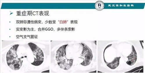 新冠确诊可否不再等核酸测定,以CT影像为诊断标准