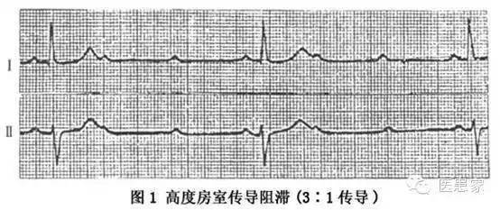 请牢记这些致命的心电图,临床医生必备