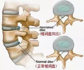 腰肌劳损 腰椎滑脱 腰椎管狭窄,这些腰部疾病该怎么治