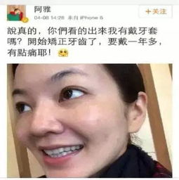 佩戴隐适美的世界冠军,完美笑容兑变