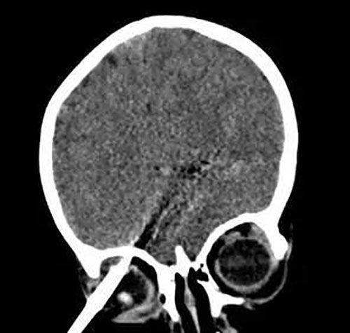 医生拔大脑钢针什么情况 10厘米钢针刺入2岁男童大脑画面令人心疼