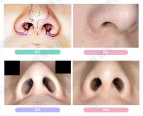巧妙应对鼻孔 鼻翼外扩,塑造自然精致的鼻部 日本医美