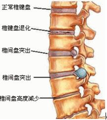 腰部受凉也能让腰椎间盘突出症复发 