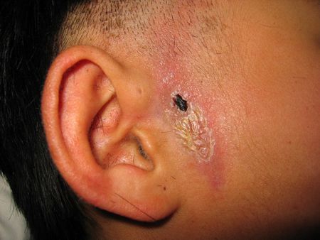 耳前瘘管手术学生险 耳前瘘管手术后复发率 
