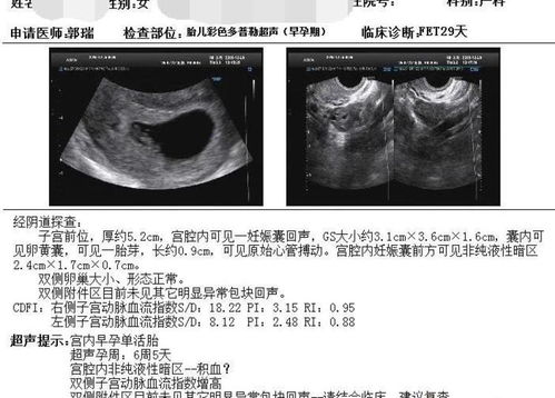 两侧输卵管虽然被切除,但最后我还是怀孕了