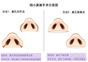 解码缩鼻翼术 MM示范缩小蒜头鼻