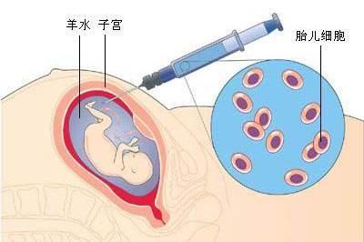 听说国外不建议做羊水穿刺 难道真的会造成胎儿流产 