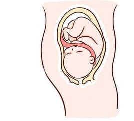 原创怀孕5个月脐带绕颈，一定要剖腹产吗？不“绕”回来会怎么样？