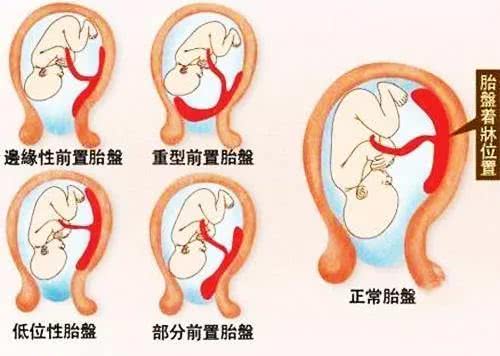 表情 胎盘离宫颈口2cm是低置,为啥正常必须大于7 腾讯新闻 表情 