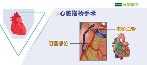 治疗冠心病,搭桥手术和支架手术哪个更好