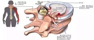 按摩被按成瘫痪 东莞上周已出现了2例