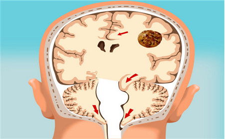 脑疝的急救措施有哪些