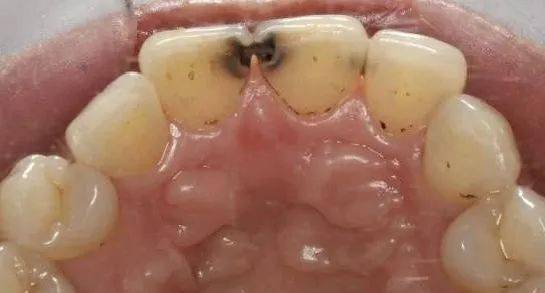 蛀牙而且牙齿变黑怎么办(蛀牙变黑还有其他办法吗?)