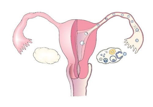 一侧输卵管通畅能怀孕吗 