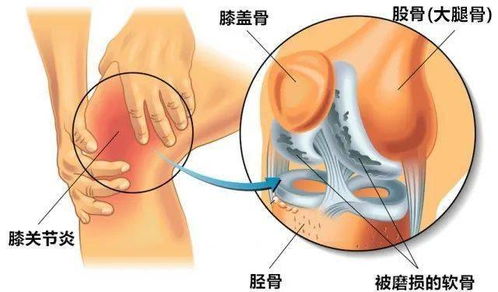 骨二科 天气转冷,如何防治老寒腿 膝骨性关节炎