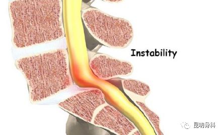 腰椎滑脱腰部酸痛,专家复位椎体除病痛
