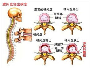 如何才能根治腰椎间盘突出 