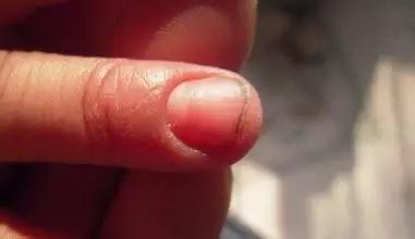 宝宝指甲感染 化脓 给宝宝剪指甲的后果