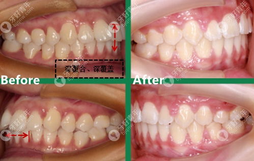 整牙可以改善上唇嘴突吗 22岁的我通过后推磨牙矫正做到了