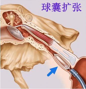 老病新治 中耳顽疾金疗法 咽鼓管球囊扩张术