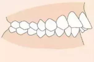 你需要做牙齿正畸吗 你适合做牙齿正畸吗