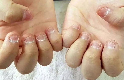 10岁男童啃指甲的坏处,小孩咬指甲有什么方法戒除