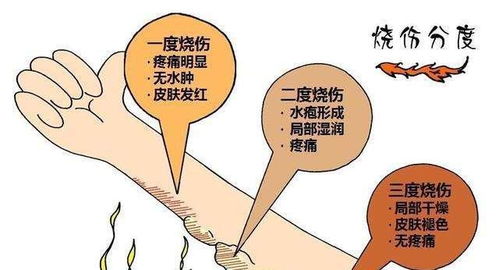 孩子烫伤腿部,到底是先脱裤子还是先冲水 一步做错伤情更严重