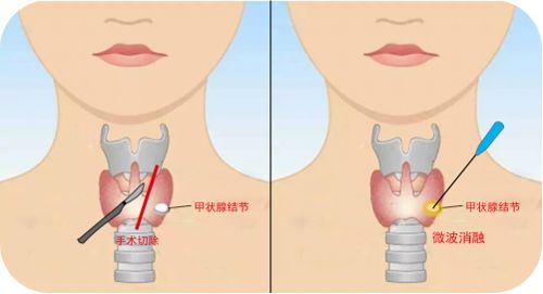 南京博豪甲状腺研究院RFA超微创消融术怎么样 带您揭秘针尖下的 无痕术