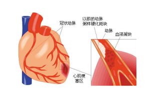 心肌梗死，用药物治疗不做搭桥术可以吗一般能有多少天生命