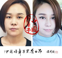 中国好鼻子同框,盘点刷屏朋友圈的男女版隆鼻靓照