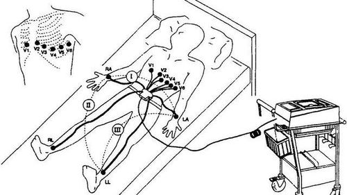 心电图导联的位置 心电图胸导联的放置位置