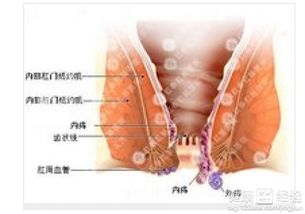 血栓性外痔一定要手术吗(血栓性外痔一定要手术吗)