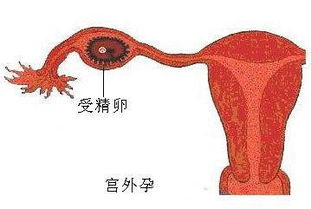 宫外孕手术 宫外孕要怎么手术