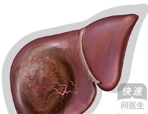 肝癌晚期会出现哪些并发症 肝癌晚期该如何治疗