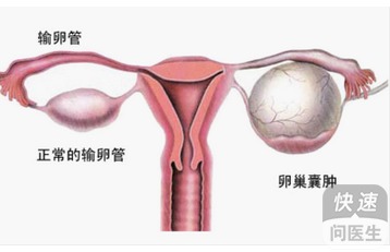 右侧卵巢囊肿症状(右侧卵巢囊肿症状表现)