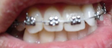 我今年二十二岁了 一颗大门牙有一部分长在了另一颗门牙的上面,就是有些重叠 前天去装了牙套, 