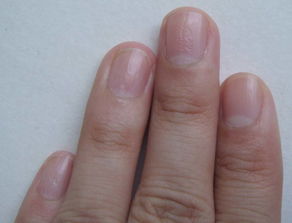 手指甲针眼状小坑是什么病,该怎么治疗 