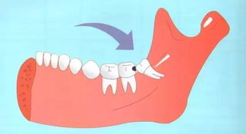 不是所有的智齿都要拔掉
