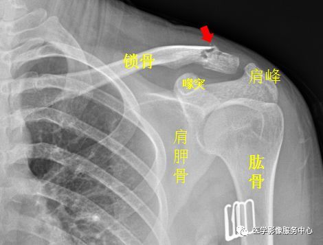 独立值班了 这些骨折你都看出来了吗 附注解