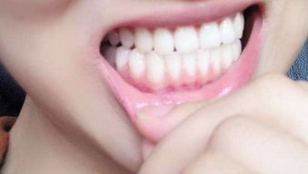 原创牙龈萎缩有什么危害？哪些人更容易被“青睐”？一次性告诉你