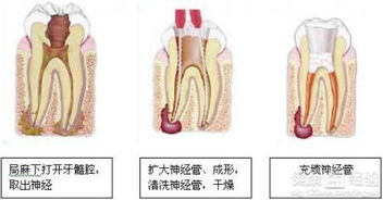 急性牙髓炎夜里疼怎么办