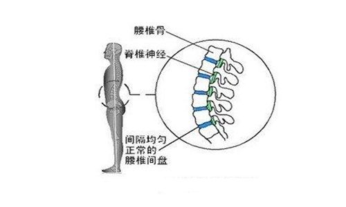 卧床休息与运动锻炼对于腰椎间盘突出都不可缺