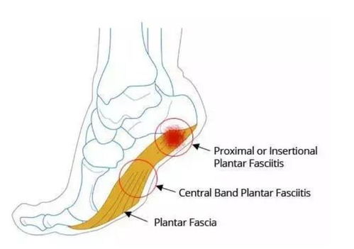 足底疼痛怎么办,是不是足底筋膜炎了