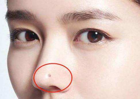 女人鼻子右侧有痣有什么含义 痣长在哪里最好